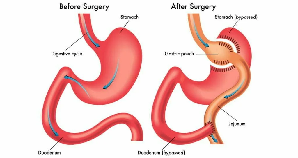 10 Key Things to Expect After Mini Gastric Bypass Surgery