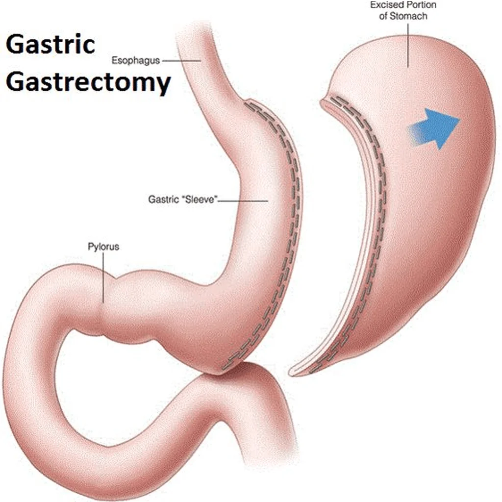 5 Transformative Success Stories: Changing Your Lifestyle with Sleeve Gastrectomy