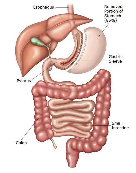 5 Ways Sleeve Gastrectomy Can Alleviate Obesity-Related Conditions