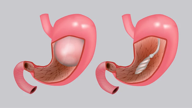 8 Key Facts About Gastric Balloons: A Non-Surgical Solution to Weight Loss