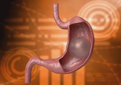 Does a Gastric Balloon Really Help?