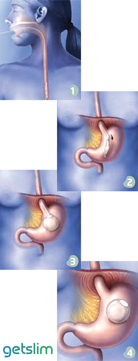 Gastric Balloon in Turkey The Procedure from Insertion to Removal