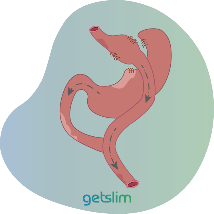 Roux-Y gastric bypass An overview