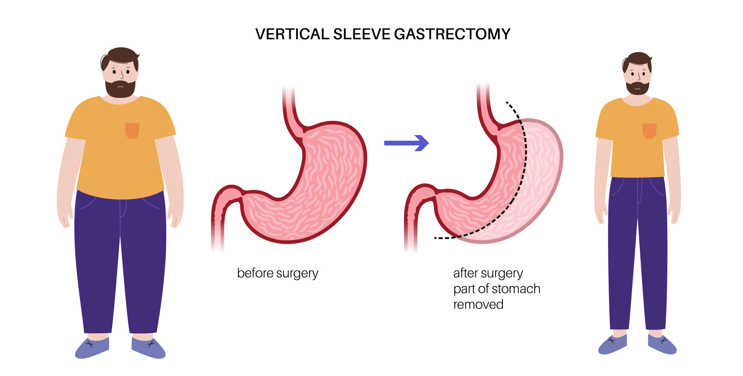 Sleeve Gastrectomy in Antalya: Procedure, Process, and Costs