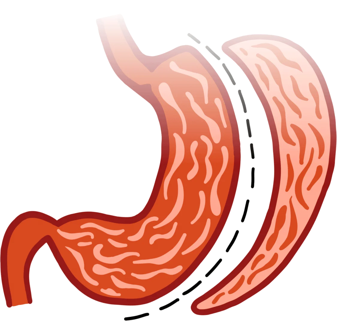 Sleeve Gastrectomy and Your Weight Loss Journey