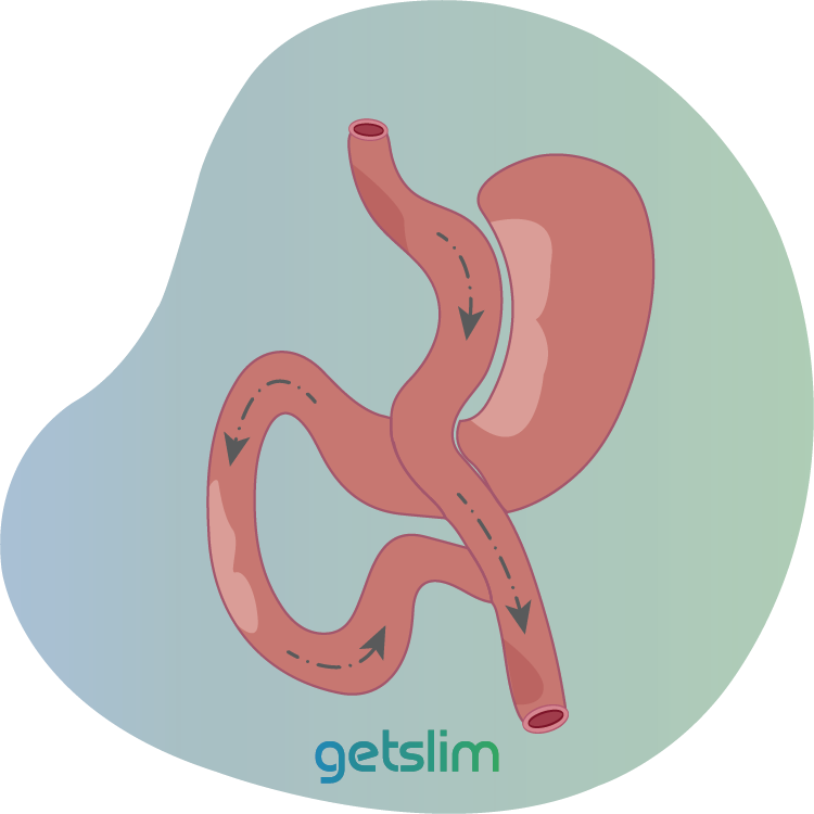 What is Mini Gastric Bypass in Turkey Antalya
