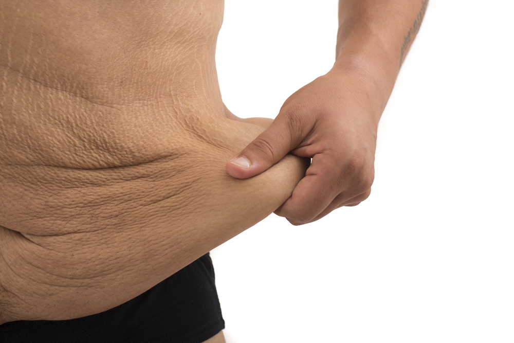 What to Do About Excess Skin After Bariatric Operation?