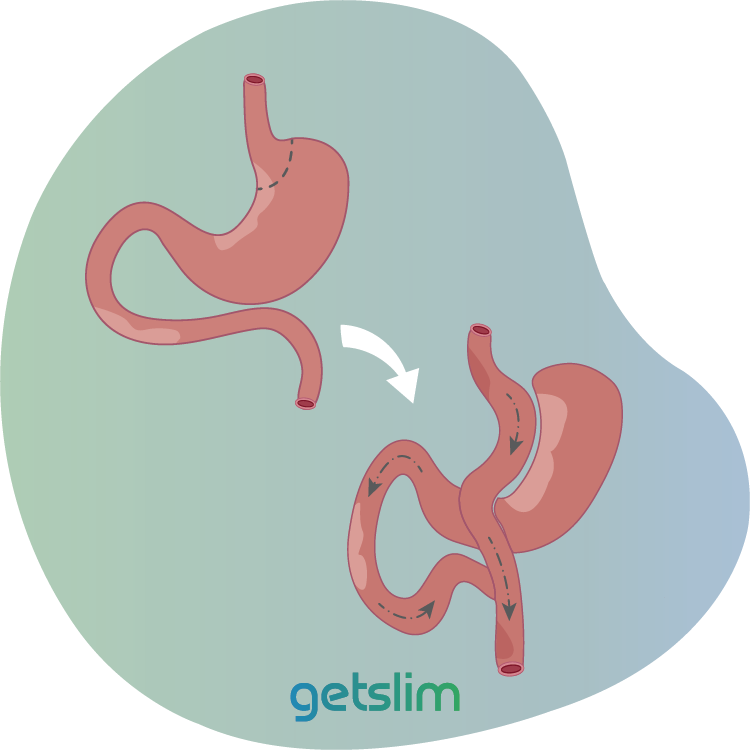 How does a mini gastric bypass in Turkey Antalya