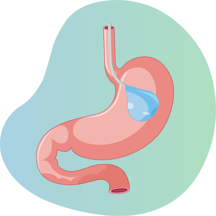 gastric balloon turkey antalya