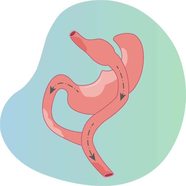 Gastric bypass surgery in TurkeyGastric Bypass Turkey Mini-Gastric-Bypass Cost & Pricing in Get Slim in Antalya